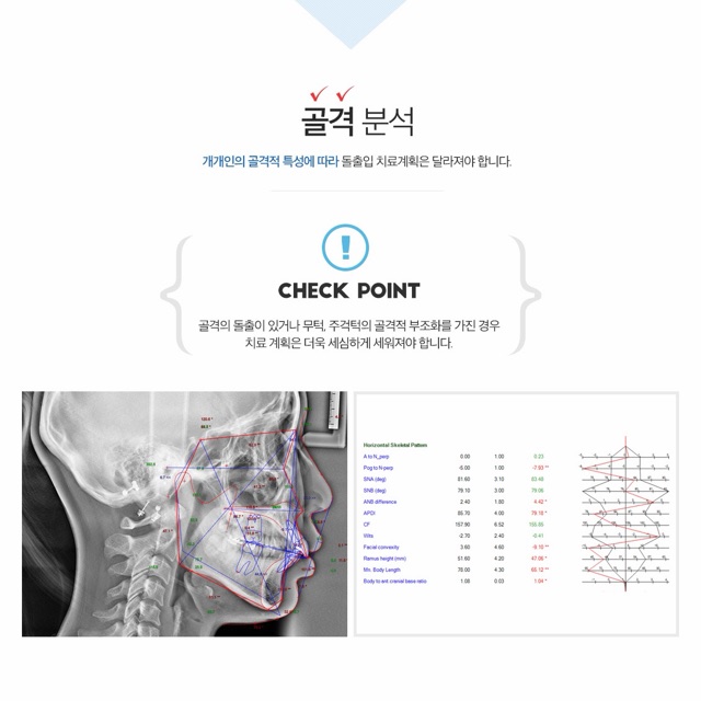 덧니인지 스스로 확인하는 방법 — 평택교정치과 기준
